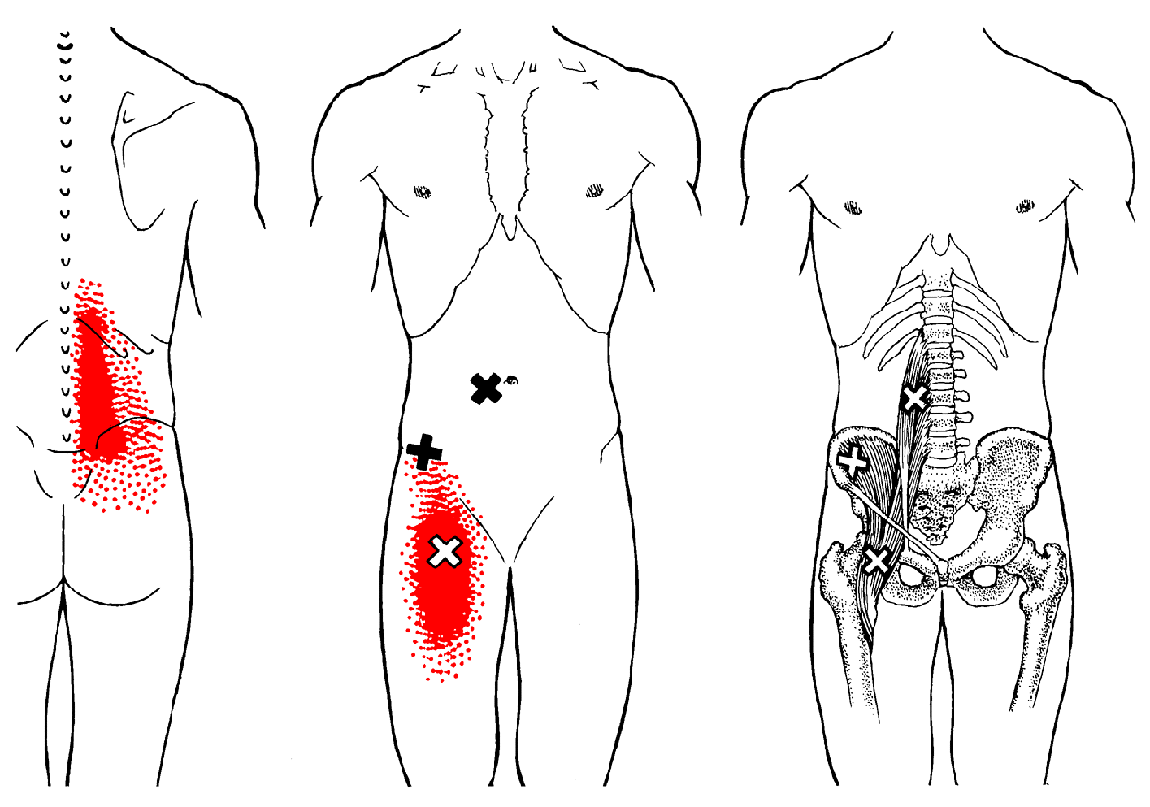 Iliopsoas Trigger point referral pattern of the iliopsoas.