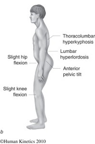hyperlordosis-lumbar-lower-crossed-syndrome Hyperlordotic lumbar -lower crossed syndrome.